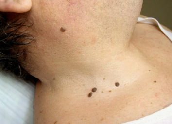 Jak Chronić Siebie i Bliskich Przed Niechcianymi Zmianami Skórnymi